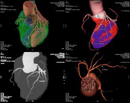 hẹp động mạch vành